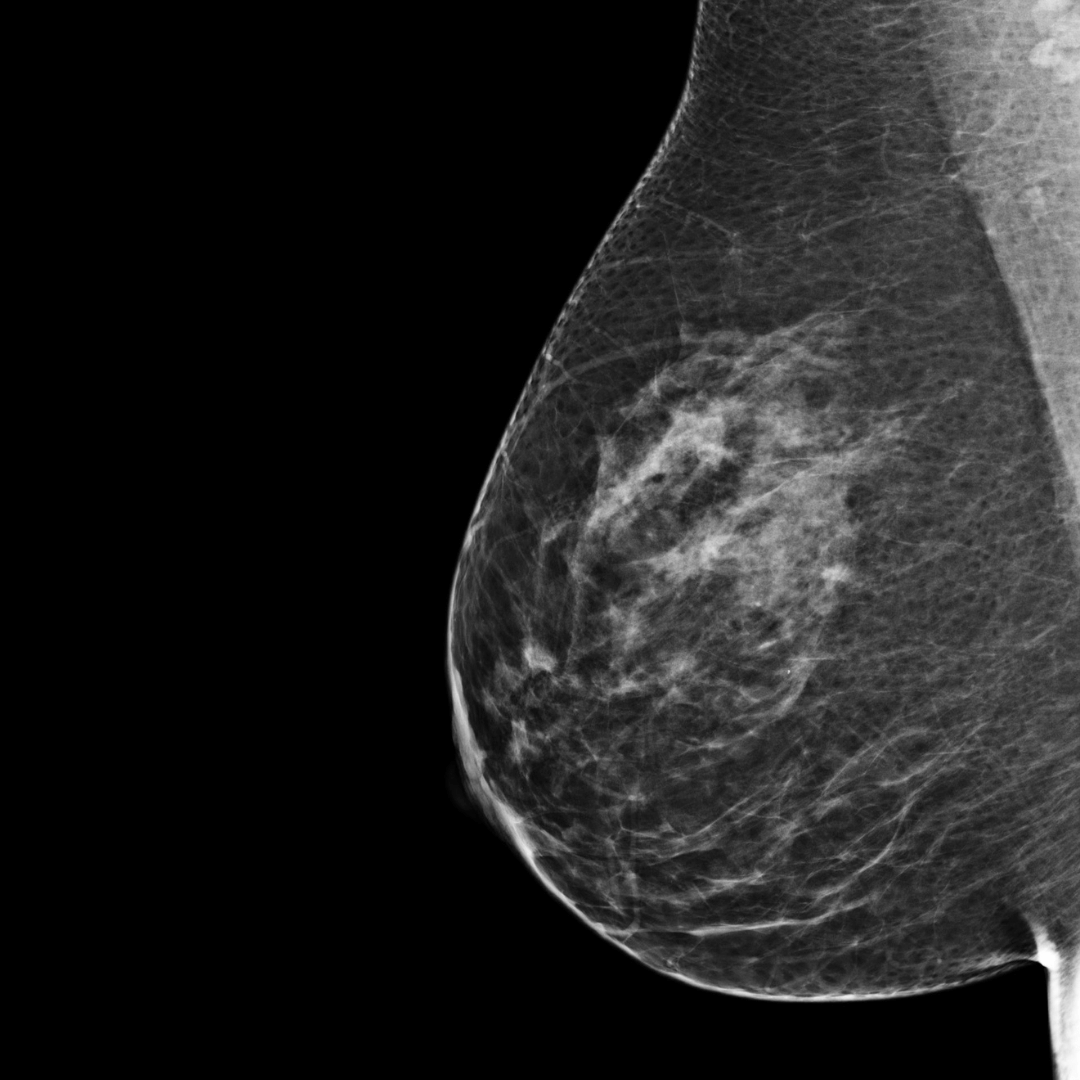 category b mammogram