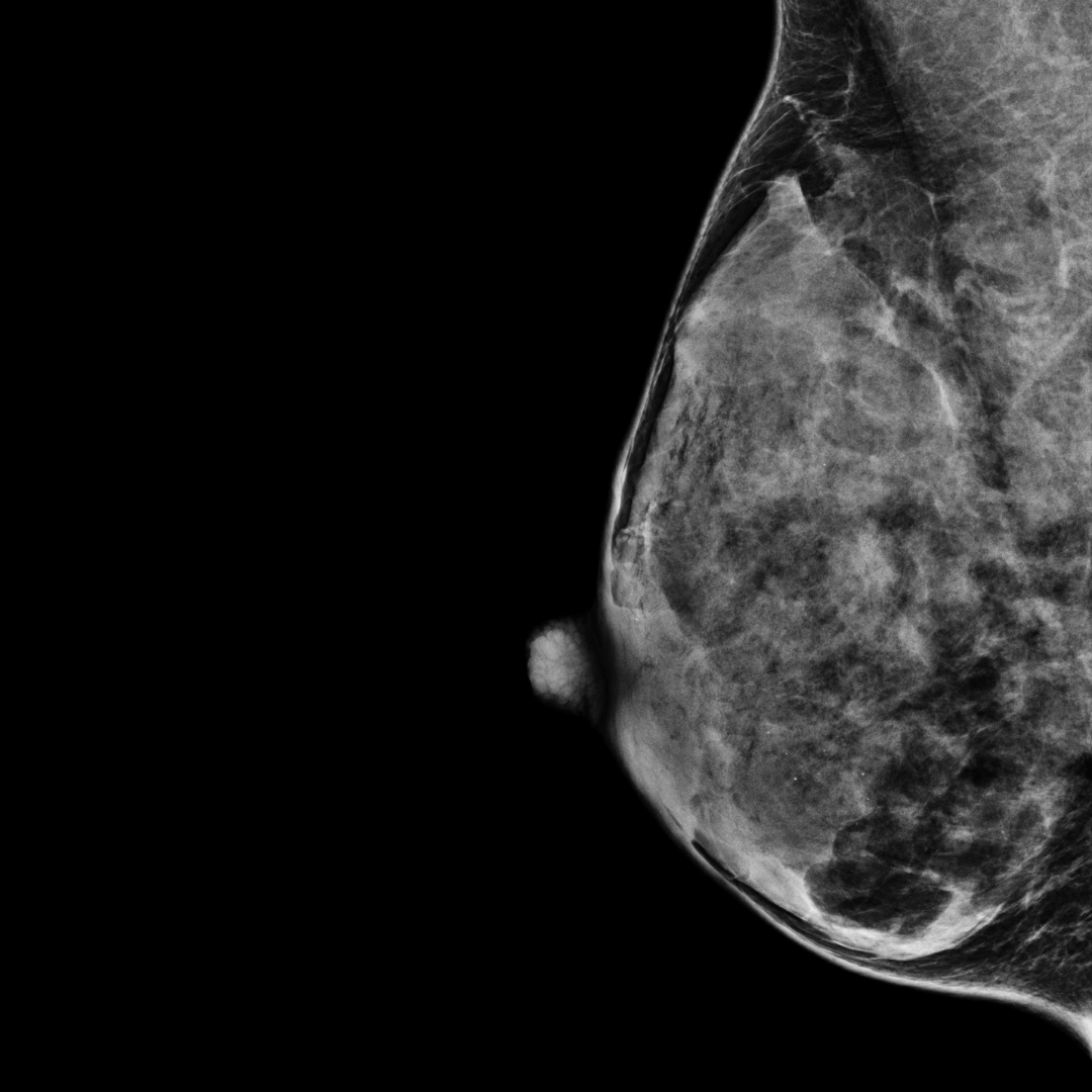category d most dense mammogram