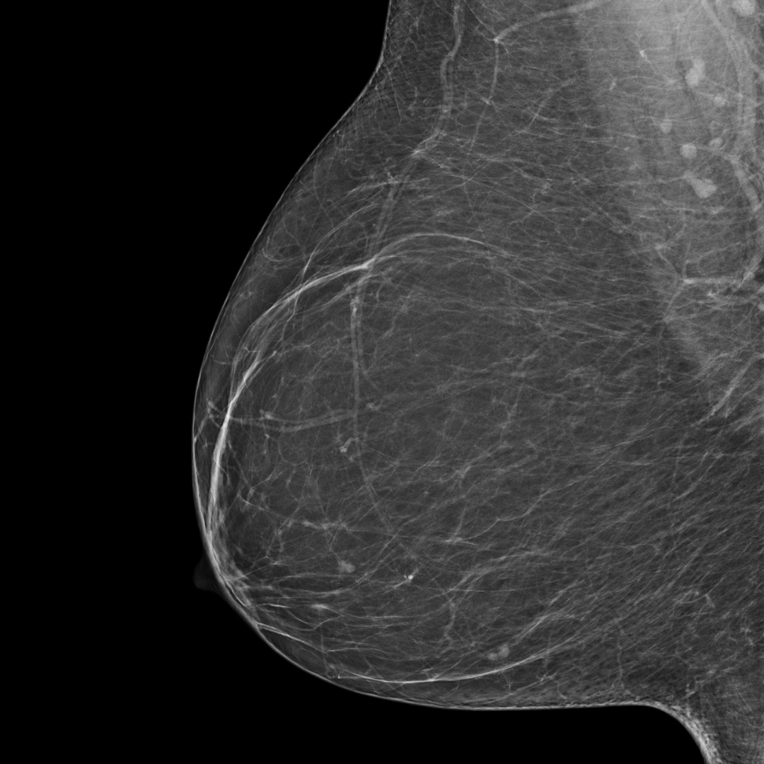 category a least dense mammogram