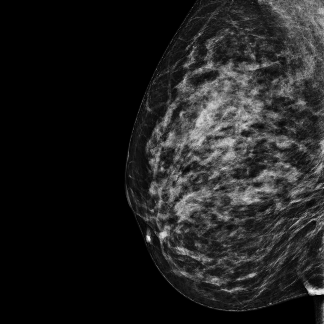 category c mammogram