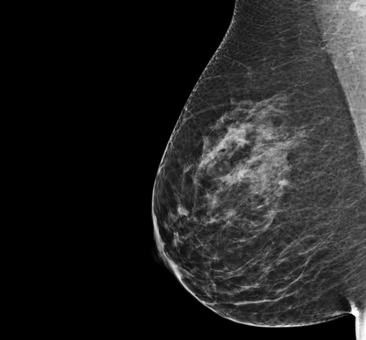 Mammogram image of a category b breast tissue